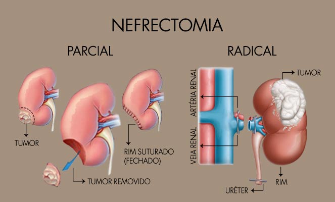 Imagens de nefrectomia