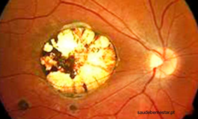 Toxoplasmose ocular fotos, imagens