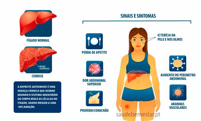 Hepatite autoimune