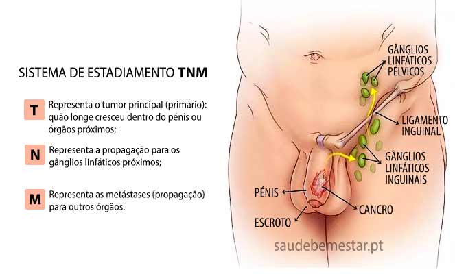 Cancro do Pénis - o que é, causas, sintomas, tratamento