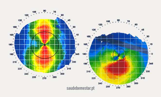Topografia corneana (de córnea), fotos, imagens