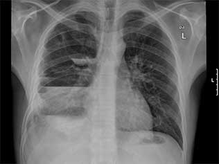 Pneumonia basal