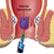 /pt/clinica/cirurgia-geral/cirurgia-de-hemorroidas/