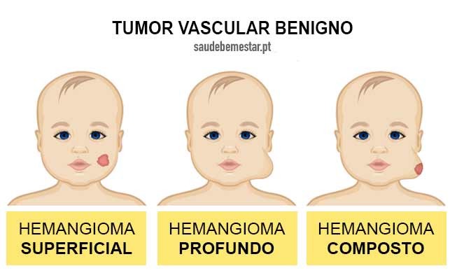 fotos de hemangioma