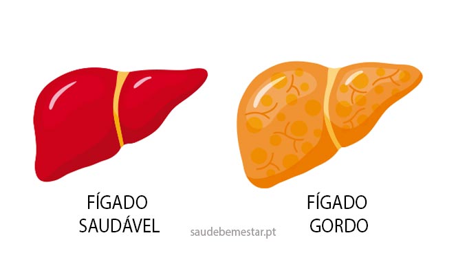 Esteatohepatite não-alcoólica