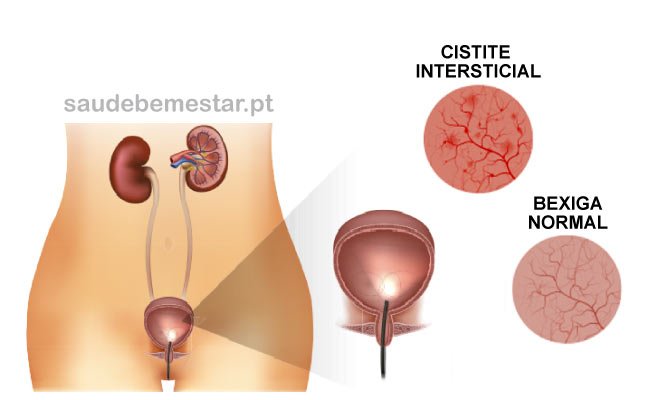 Queimação nas Partes Íntimas: Causas e Soluções para o Bem-Estar