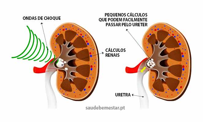 Fotos, imagens de litotrícia