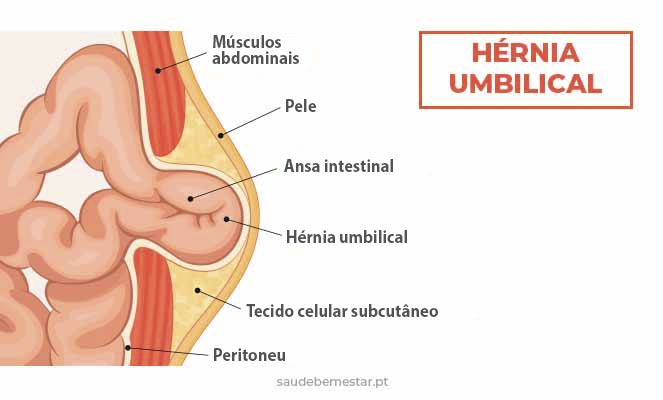 Hérnia abdominal - causas, sintomas, tratamento, cirurgia