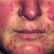 /pt/clinica/dermatologia/rosacea/