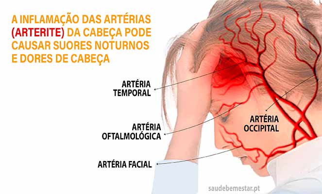 Arterite temporal - o que é, causas, sintomas, tratamento