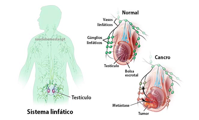 Cancro do testículo