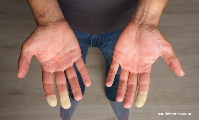 fenómeno de Raynaud ou síndrome de Raynaud