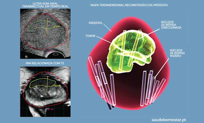 Biópsia da próstata de fusão