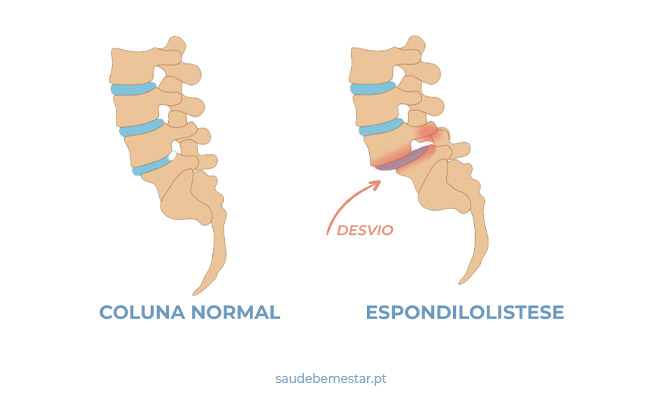 Espondilolistese