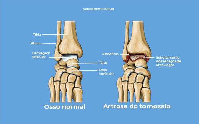 Artrose do tornozelo