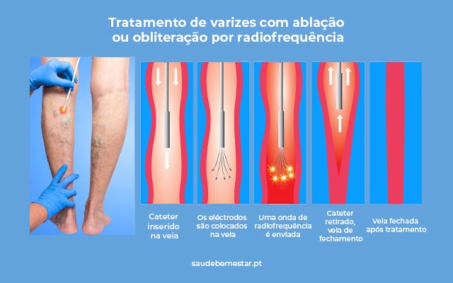 Cirurgia de varizes