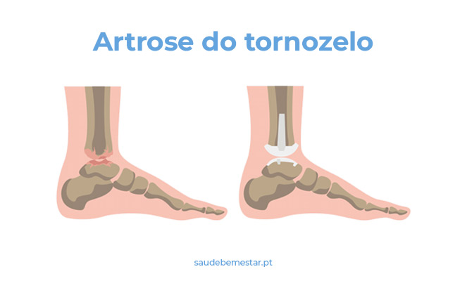 Cirurgia na artrose do tornozelo