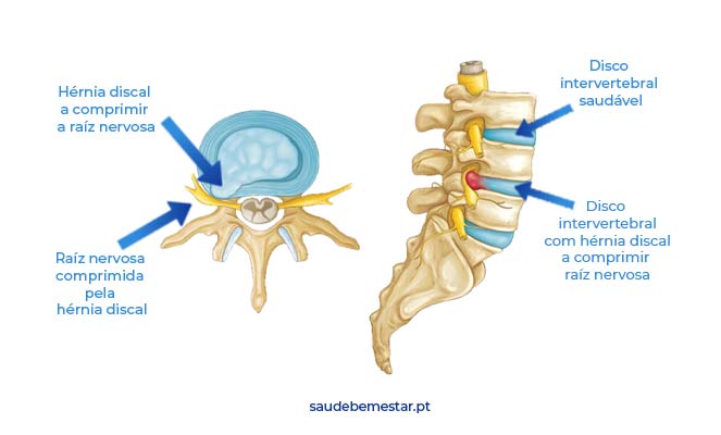 https://www.saudebemestar.pt/media/89761/hernia-discal.jpg