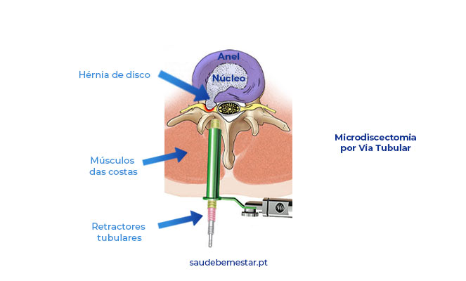 Cirurgia nas hérnias de disco