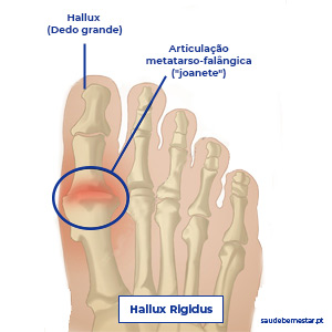 Hallux rigidus