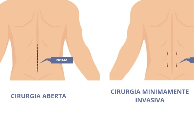 Cirurgia da coluna