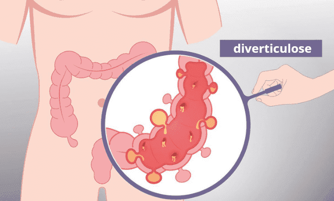 Diverticulose