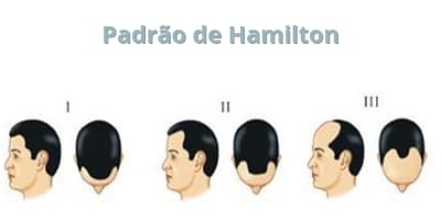 Padrão de Hamilton