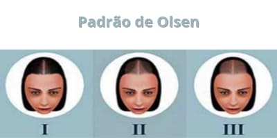 Padrão de Olsen