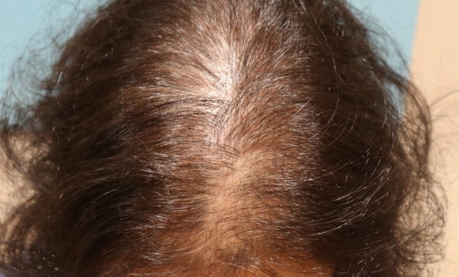 Alopecia feminina (nas mulheres)