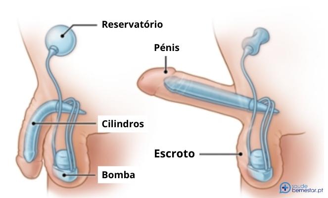 Próteses do pénis