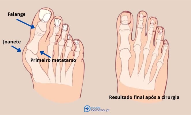 Cirurgia de joanete