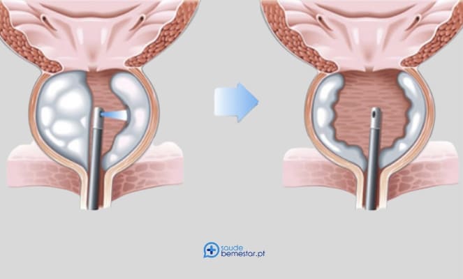 Cirurgia da próstata a laser