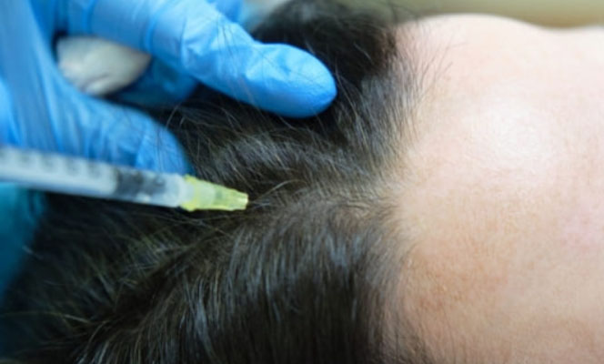 Mesoterapia capilar