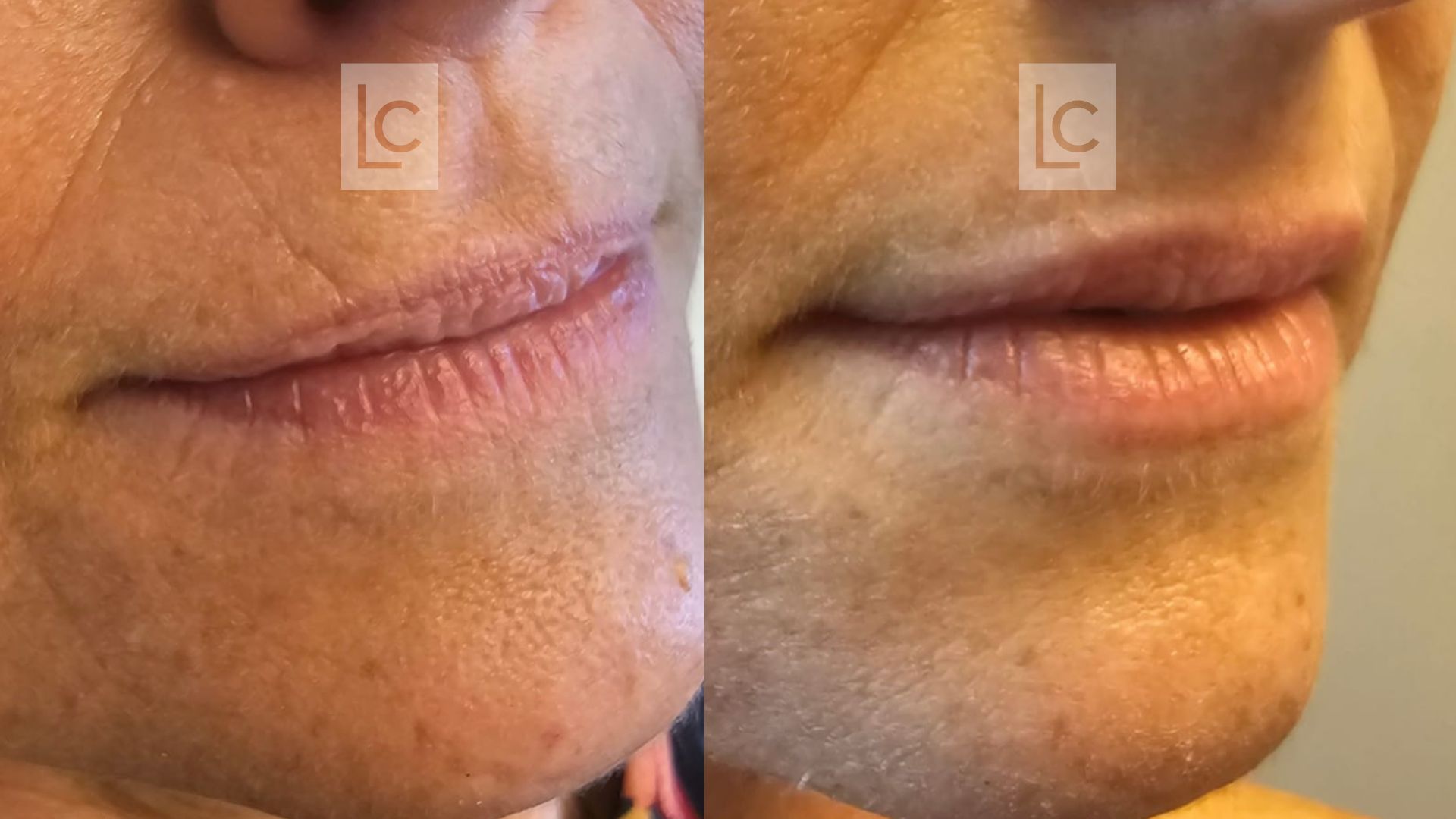 Antes e depois do preenchimento labial