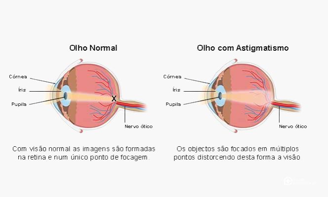 Astigmatismo fotos, astigmatismo imagens