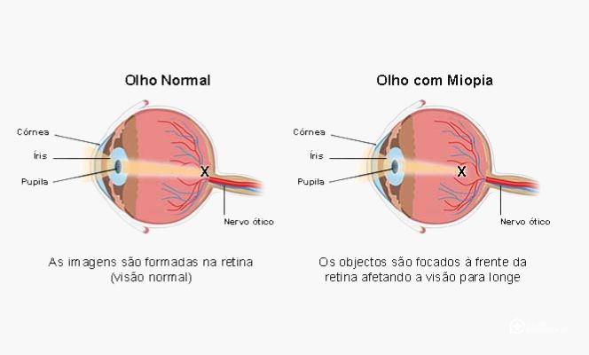 O que é miopia, olho com miopia, fotos, imagens