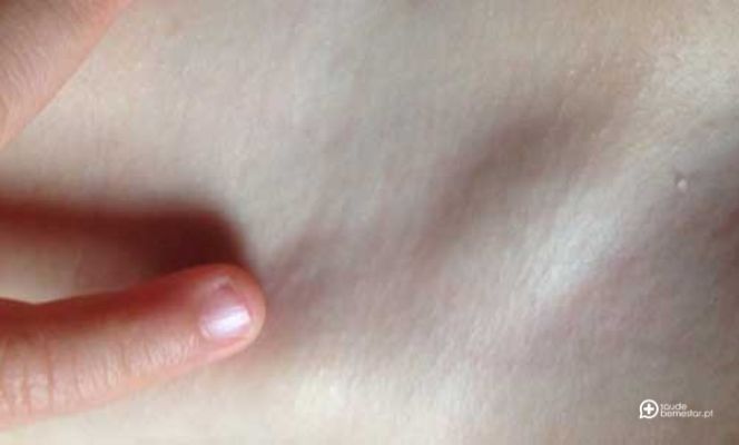 Hérnia inguinal - fotos